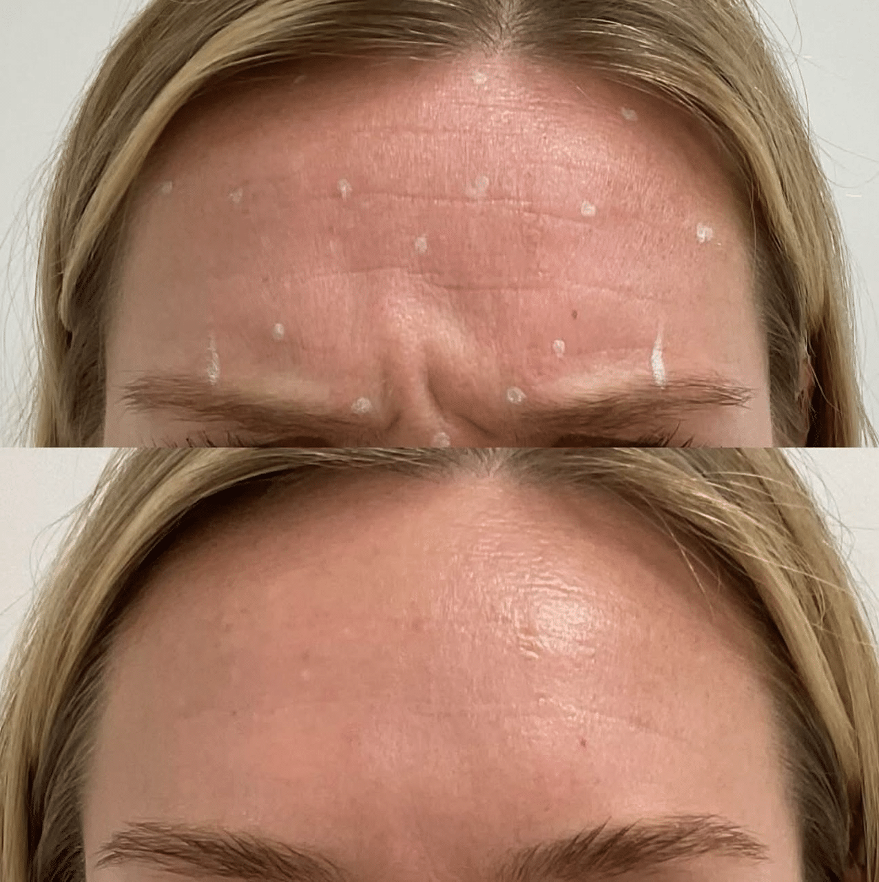 injectables-gallery-4