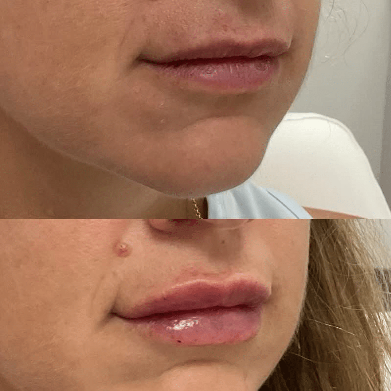injectables-gallery-5